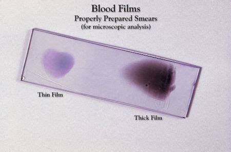 Blood Smear Test | Procedure & Possible Results - Lesson | Study.com