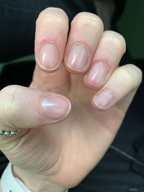 Any Suggestions On How To Fix This My Cuticles And Skin Surrounding