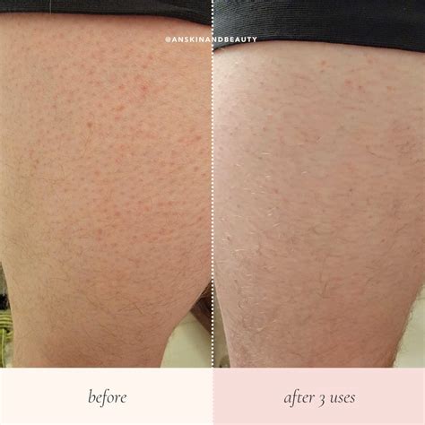 Keratosis Pilaris