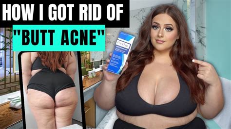 How I Got Rid Of Butt Acne 5 Steps Youtube