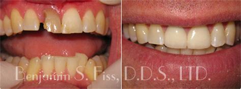 Porcelain Veneers In Chicago IL Chicago Benjamin S Fiss D D S