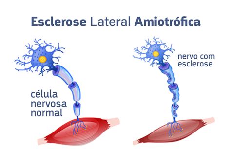 Esclerose Lateral Amiotr Fica Guia Sa De Cidades