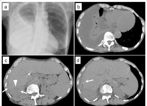 Chest Radiography And Ct At The Time Of Pleural Empyema Diagnosis A