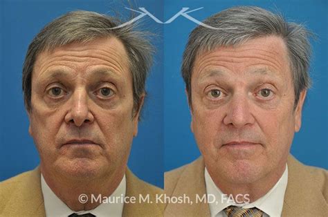 New York Nasal Valve Collapse Repair Maurice M Khosh Md Facs