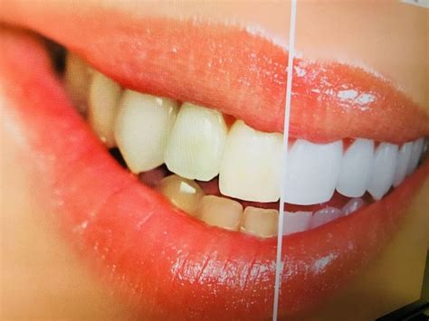 C Mo Se Hace Un Blanqueamiento Dental Cl Nica Dental Guadentis