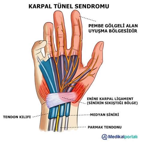 Beyaz Yakalıların Kabusu Karpal Tünel Sendromu