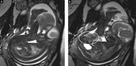 Male Sexual Development In Utero Testicular Descent On Prenatal