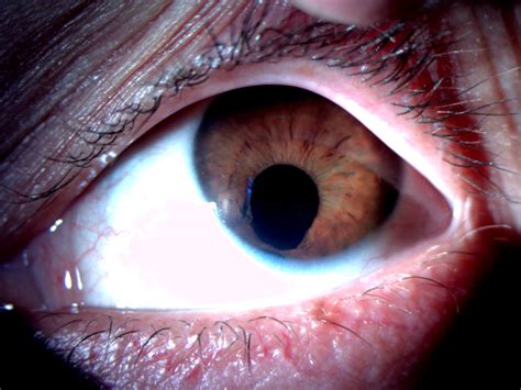 Iris Coloboma Ocular Surface Org