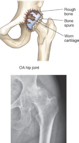 Pta Osteoarthritis Hip Fracture Piriformis Syndrome Flashcards