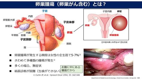 解説＃1 “卵巣がん“という病気を知って欲しい！ 卵巣がん：診断と治療を支えたい！aiを用いた新規予測システムの開発（古宇 家正（広島大学大学