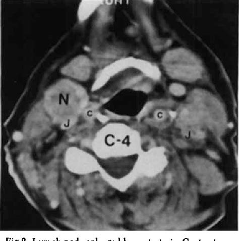 Figure From Computed Tomography Of Internal Jugular Vein Thrombosis