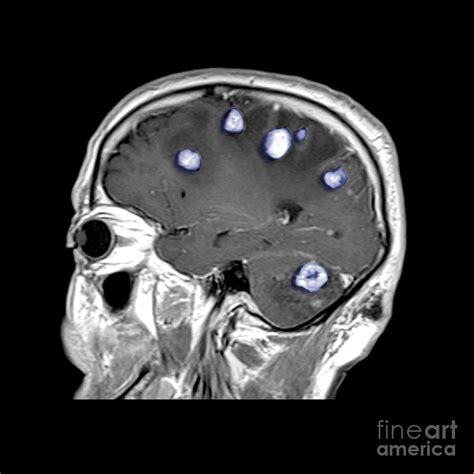 Brain Tumors Photograph by Medical Body Scans