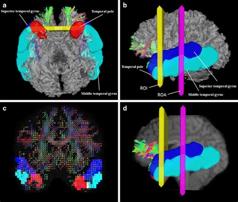 Reconstruction Of The Uncinate Fasciculus Uf Using Three Seed Regions