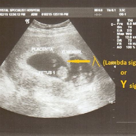 Transverse ultrasound image of chorionic membrane in dichorionic ...