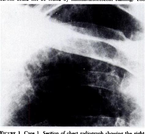 Figure 1 From Clinicalmi Chronic Pneumocystis Carinhi Pneumonia In Aids Semantic Scholar