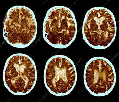 Brain With Alzheimer S Disease Ct Scan Stock Image F