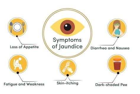 Symptoms Of Jaundice Public Health Notes