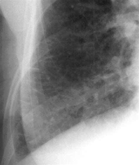 Icu Chest Films