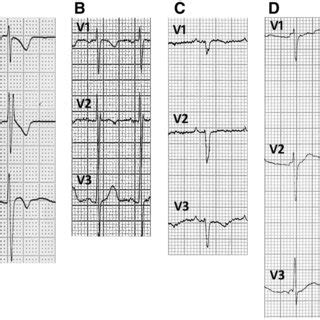 Intraventricular Conduction Delay Examples Of Ecg Recordings Showing