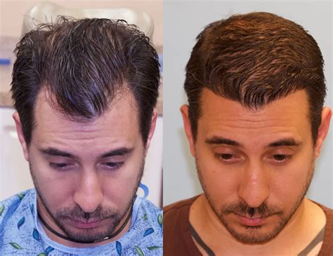1500 Graft Hairline Restoration - Carolina Hair Surgery