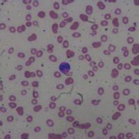 Peripheral Smear Showing Dysplastic Bilobed Neutrophils. | Download ...