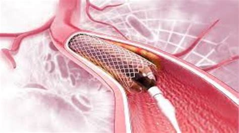 Cost Of Angioplasty In India