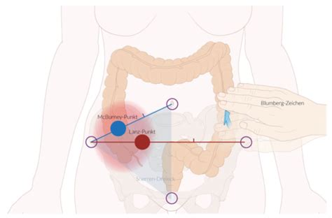 Appendizitis Karteikarten Quizlet