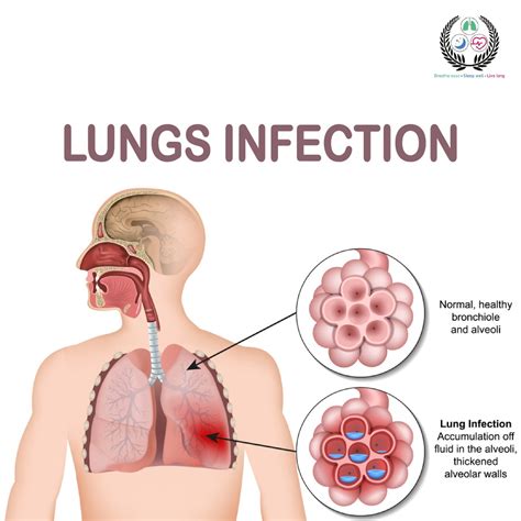 Lung Infections Demystified: Types, Symptoms, Treatment