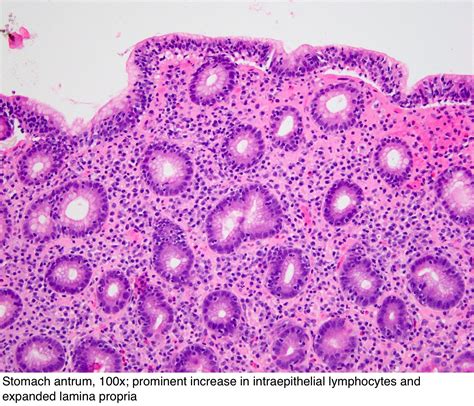 Pathology Outlines Lymphocytic Gastritis