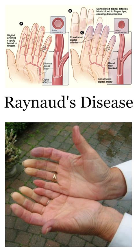 Raynaud S Disease Syndrome