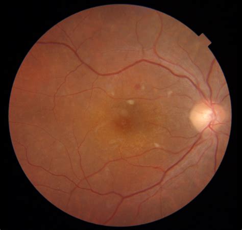 Overview Of Hypertensive Retinopathy Its Symptoms Causes And Treatment