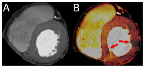 Diagnostics Free Full Text Coronary Computed Tomography Vs Cardiac