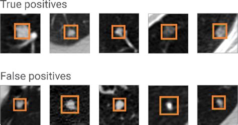 Figure 3 From Lung Nodules Detection And Segmentation Using 3D Mask