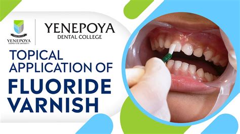 Topical Application Of Fluoride Varnish Pediatric Preventive