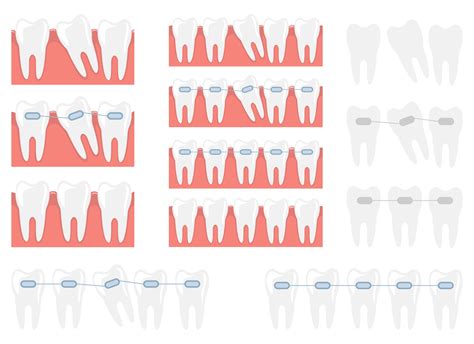 Braces vector design illustration set isolated on white background ...