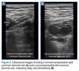 Blood Clot In Leg Ultrasound