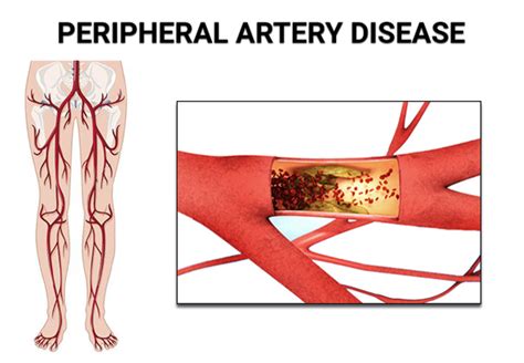 Peripheral Artery Disease Treatment Health Benefits Member Article By