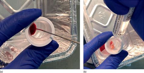 How To Do Endoscopic Ultrasound‐guided Liver Biopsy Radiology Key