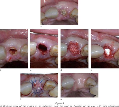 Normal Healing After Tooth Extraction