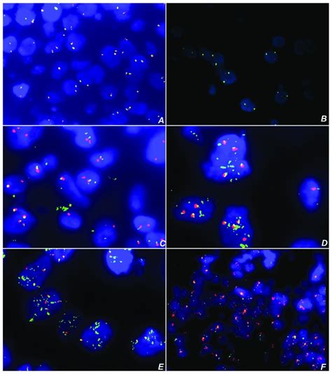 Lsi Chop Break Apart Rearrangement In Liposarcoma Lps Tissues A