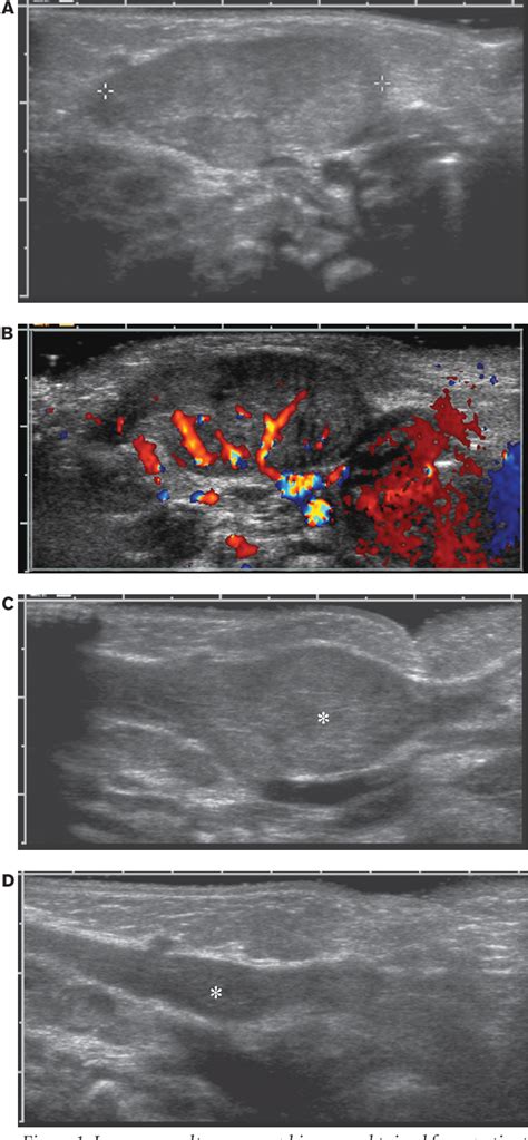 Figure 1 From The Presentation And Management Of Fibromatosis Colli Semantic Scholar