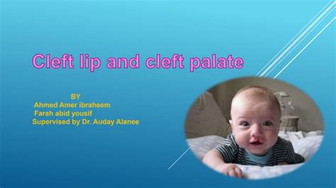 Genetic Of Nonsyndromic Cleft Lip And Palate