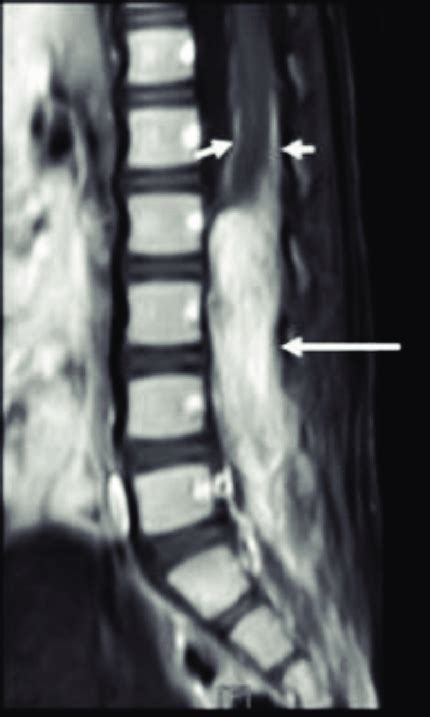 Contrast Enhanced Sagittal T Weighted Lumbosacral Mr Image Shows