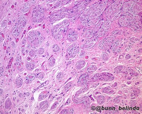 Traumatic Neuroma Pathology Outlines