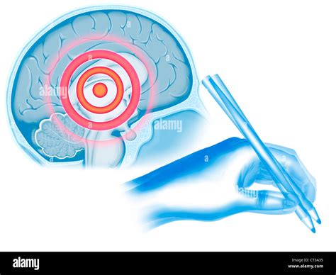 Parkinsons Disease Drawing Stock Photo Alamy