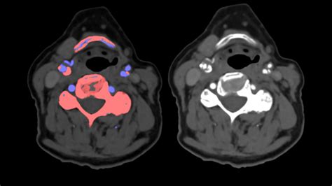 The Difference Between Images And Answers With Dual Energy CT Siemens