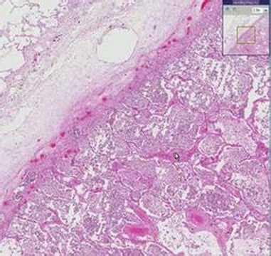 Lobar Pneumonia Histology