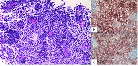 Hematoxylin And Eosin 200x Magnification A Expression Of Cd117 400x