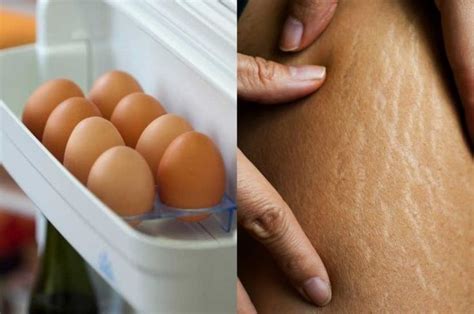 Uangnya Mending Disimpan Stretch Mark Bisa Hilang Tanpa Perlu