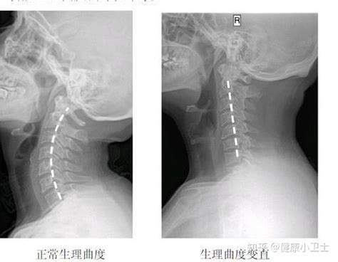 枕啤酒瓶能治颈椎病？ 知乎